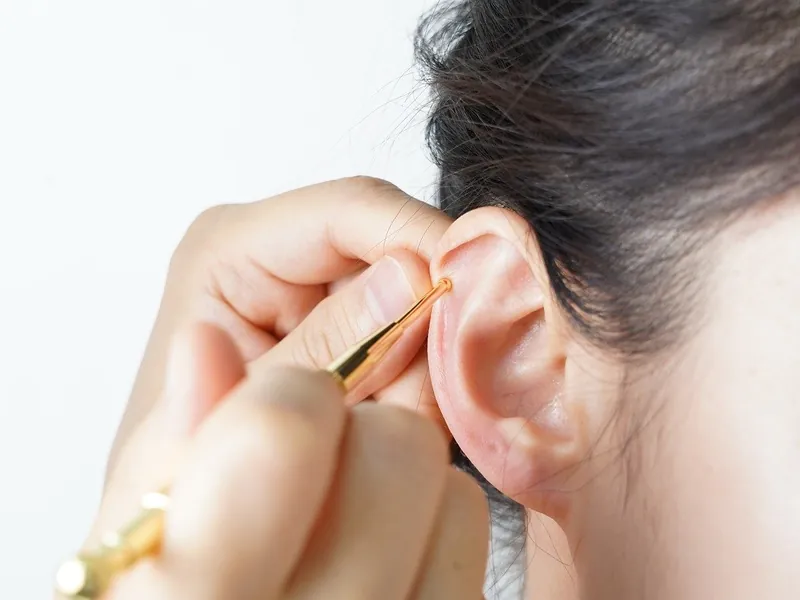 Auricular Therapy