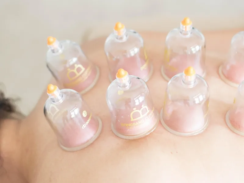 Cupping Therapy